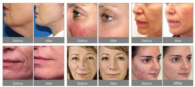Hydrofacial H2 O2 Aqua Peel Water Dermabrasion Hydra Facial Face Skin 