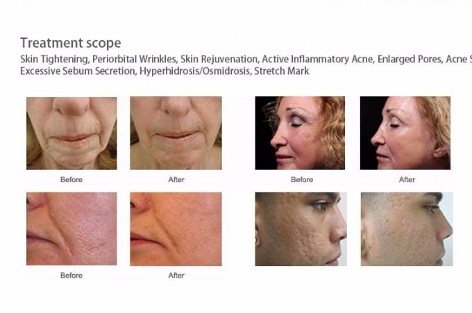 Morpheus8 Microneedling RF Radiofrequency Fractional Resurfacing Treatment Skin Rejuvenation  Tightening Loose Skin